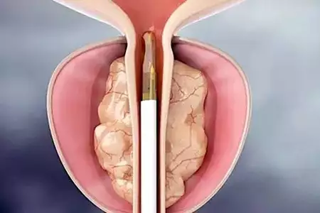 How I've kept my prostate healthy for five years