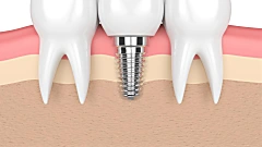 You Might be Surprised by Dental Implant Pricing for 2019