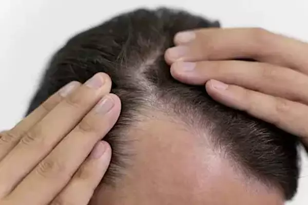 The #1 Mistake People Make When They Notice Their Hair Is Thinning