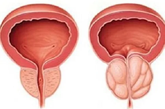 Do this Immediately if You Have Enlarged Prostrate (Watch) Do this Immediately if You Have Enlarged Prostrate (Watch)