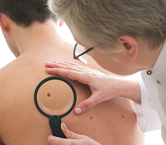 3 Ways Melanoma Can Spread