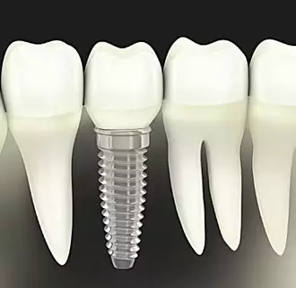 Here's What New Dental Implants Should Cost in 2020