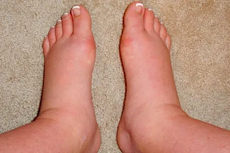 Forget Furosemide, Use This Household Item To Help Drain Edema Fluid