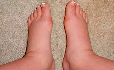 Forget Furosemide, Use This Household Item To Help Drain Edema Fluid