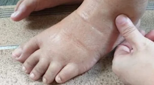 Forget Furosemide, Use This Household Item To Help Drain Edema Fluid