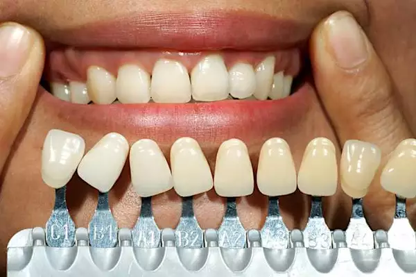 Here Is What Full Mouth Dental Implants Might Cost You in Dubai