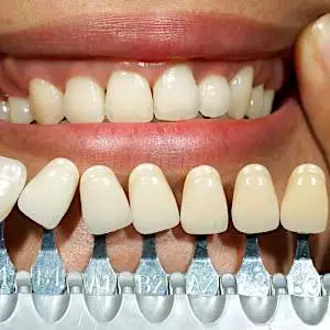 Here Is What Full Mouth Dental Implants Might Cost You in Dubai