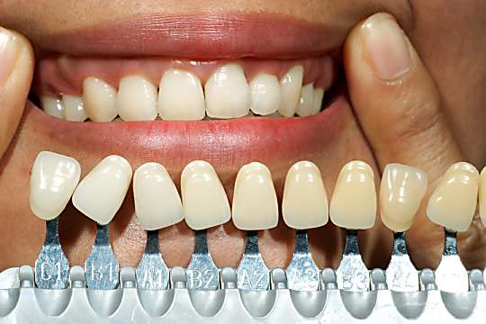 Here Is What Full Mouth Dental Implants Might Cost You in Dubai