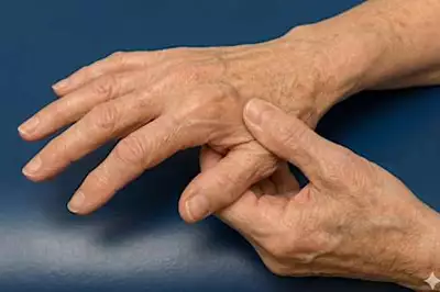 Artrosi: scoperta una nuova terapia che riaccende la speranza Artrosi: scoperta una nuova terapia che riaccende la speranza