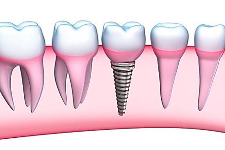 See what full mouth dental implants may cost you