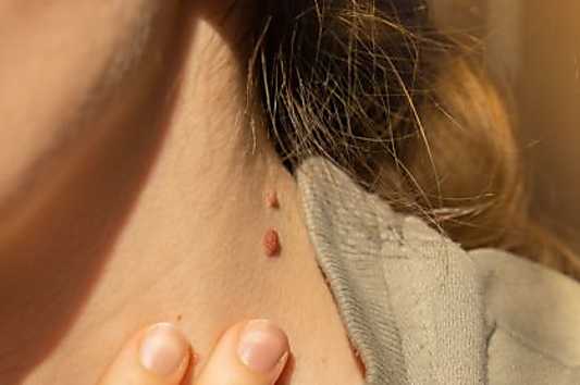 Do This Immediately If You Noticed Moles Or Skin Tags (It's Genius)'s Genius)