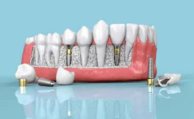 The Actual Price Of A Full-Mouth Dental Implant In 2024