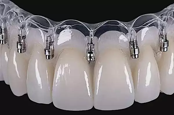 Τι ισχύει για εμφυτεύματα στο δημόσιο το 2025