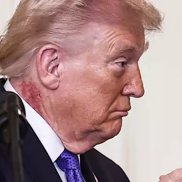 Υγεία του Προέδρου των ΗΠΑ: Κόκκινη κηλίδα στον λαιμό του Τραμπ πυροδοτεί εικασίες – Δήλωση του Λευκού Οίκου