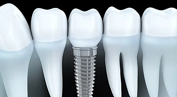 Implantes dentários: lista de preços