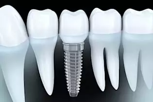 Ecco quanto dovrebbe costare un impianto dentale nel 2020