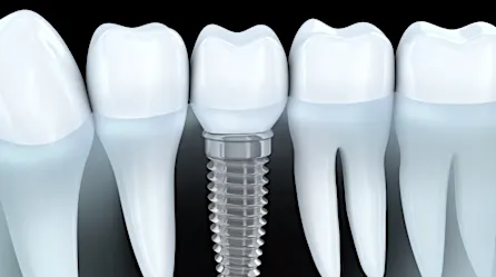 Aquí le mostramos cuánto cuestan los nuevos implantes dentales