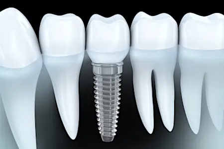 Ecco i veri prezzi degli impianti dentali nel 2019 Ecco i veri prezzi degli impianti dentali nel 2019