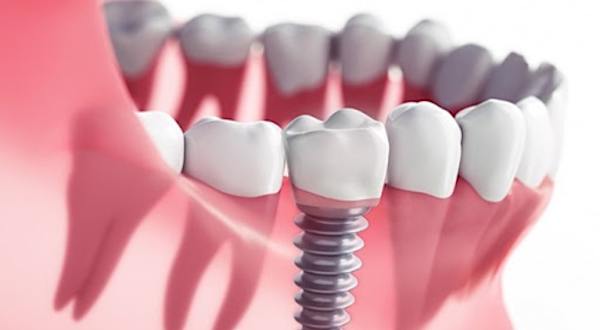 Aparência e sensação de dentes de verdade: aqui estão os preços