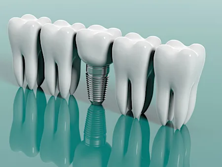 Explore Various Dental Implant Options