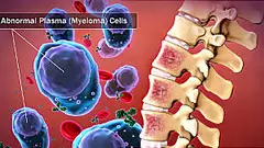 Learn more about multiple myeloma here