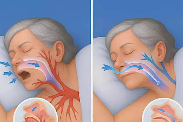 El truco contra la apnea del sueño que los médicos nunca mencionan, pero que los pacientes adoran