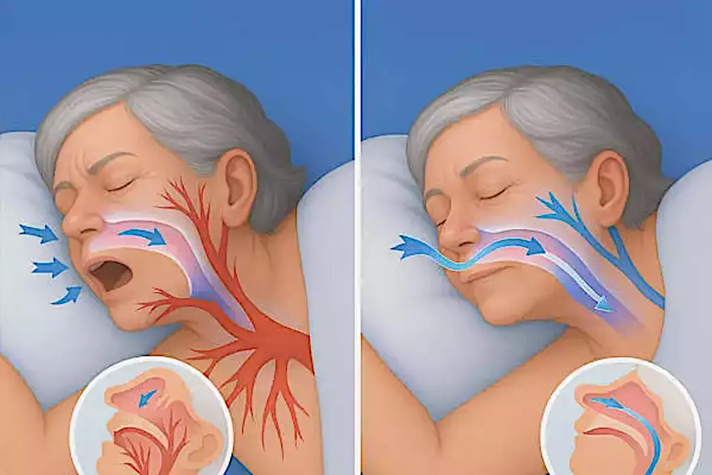 A Simple Method Against Snoring and Sleep Apnea (It’s Genius!)