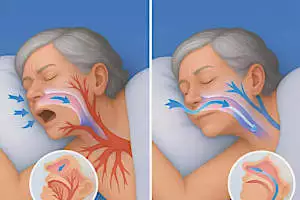 The Sleep Apnea Trick Doctor Never Mention – But Patients Love It