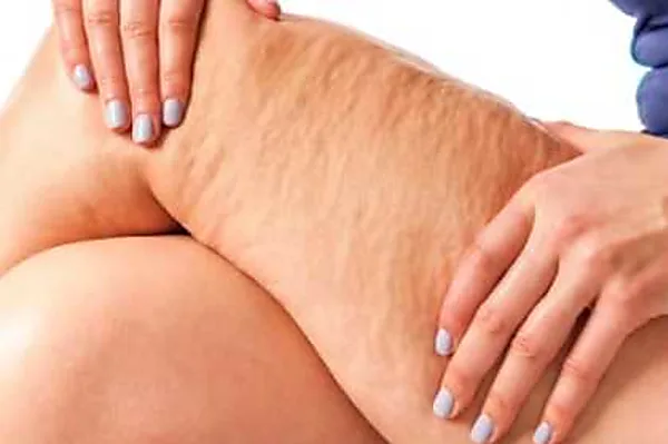 Cellulite After 50: Do This Tonight Before Bed (Takes 1 Minute!)