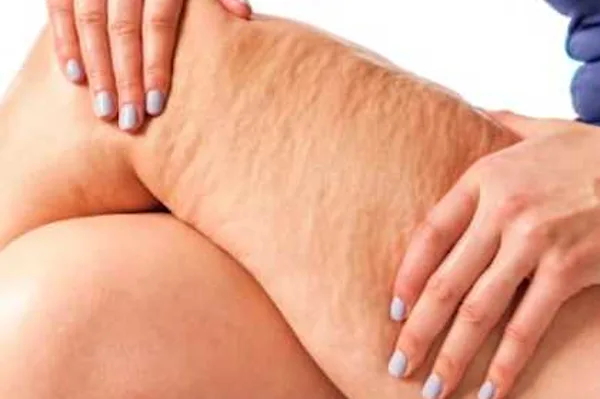 Cellulite After 50: Do This Tonight Before Bed (Takes 1 Minute!)