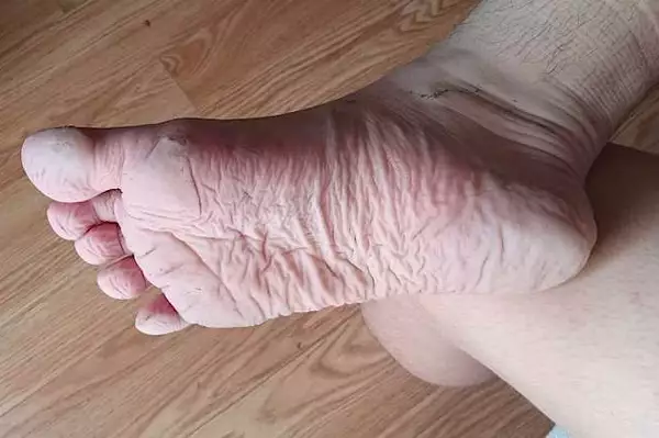 Diabetes and Numb Feet? Put These In Your Shoes