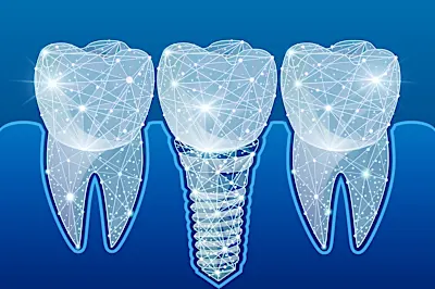 The Actual Price of Whole Mouth Dental Implants In Spain. See The List