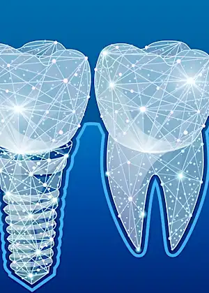 The Actual Price of Whole Mouth Dental Implants In Spain. See The List