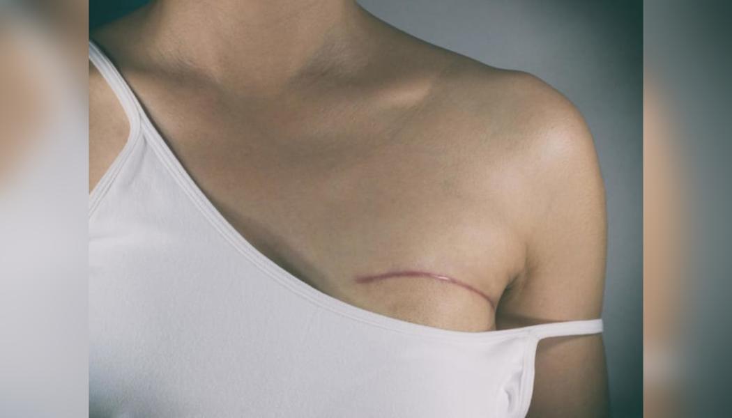 Life after preventive mastectomy: A woman’s journey to accepting her new body