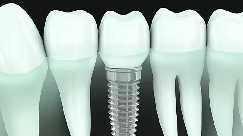 Here's What New Dental Implants Should Cost in 2021