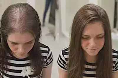 The Surprising Household Item People Are Using for Hair Regrowth The Surprising Household Item People Are Using for Hair Regrowth