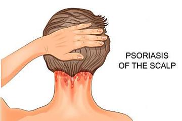 About Scalp Psoriasis: Learn About Causes & Symptoms. Search For Moderate To Severe Scalp Psoriasis