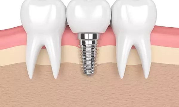 Here Is What You Should Pay For Dental Implants in 2020