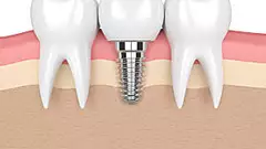 Dental Implants in 2019 are Now More Affordable Than Ever! See Here