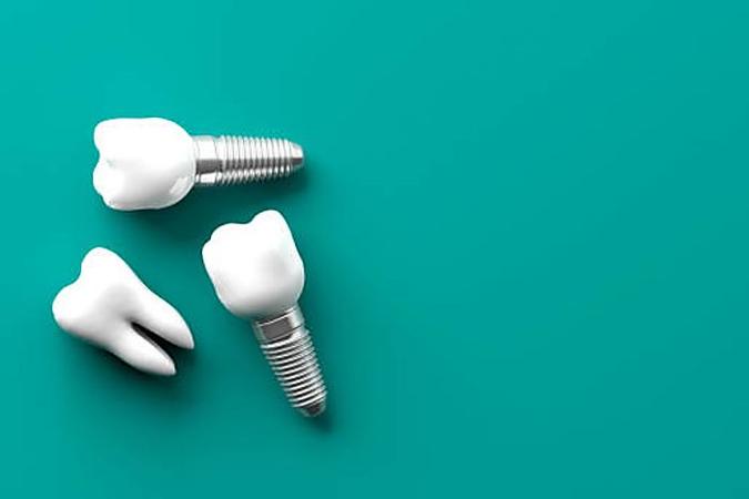 Here Is What New Dental Implants Should Cost You in Trenton