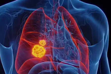 Seniors Over 55 With COPD Should Do This Immediately (It's Genius)