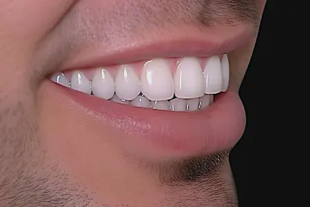 What Are Screwless Dental Implants, And How Much Do They Cost?