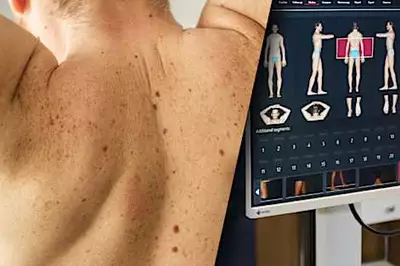 Μάθε τι πρέπει να κάνεις για πρόληψη καρκίνου του δέρματος