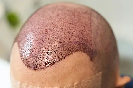 Hair Transplant Treatments That Actually Work