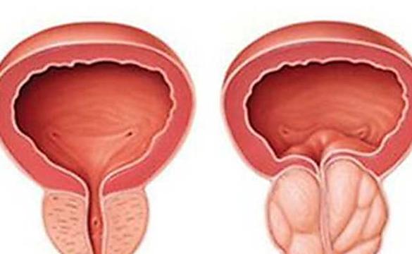 Urologist: Try This If You Have Enlarged Prostatic (Watch)