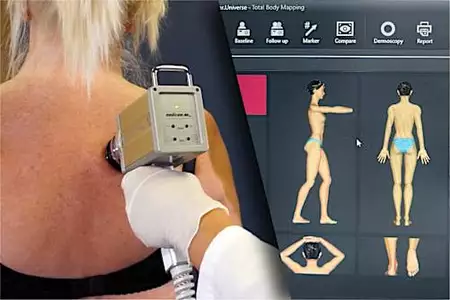 Μάθε πώς μπορείς να προλάβεις το μελάνωμα