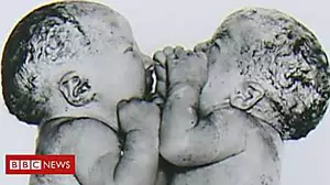 Conjoined twins: We were one big baby
