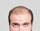 Calvície tem cura? Essa nova descoberta pode ter a resposta ideal.
