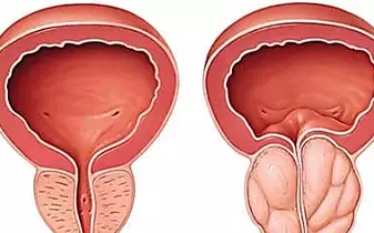Urologist: Plenty of Men With An Enlarged Prostate Do Not Know About This Simple Solution