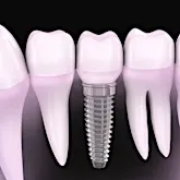 Dental implants cost in 2019 may surprise you